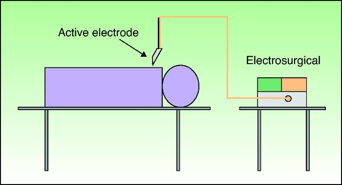 In Fulguration Configuration, the electrode does not touch the skin or tissue and once the spark occurs the current flows from the tip of the electrode down to earth following the path of least resistance.