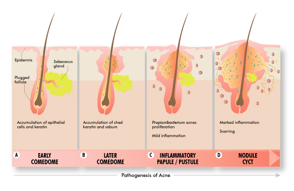 acne stages
