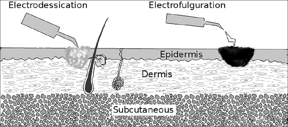 electrodesiccation-electrofulguration