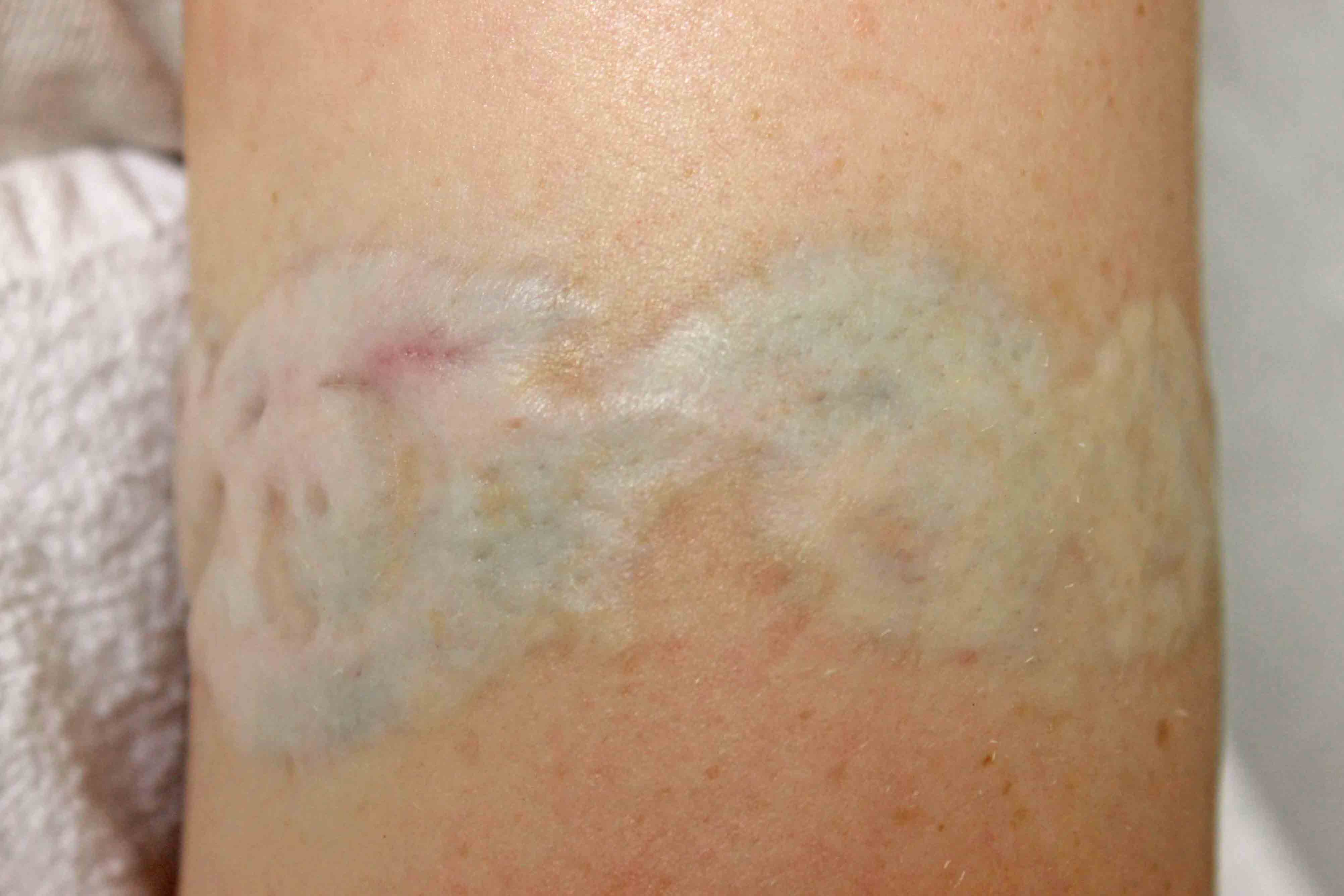 Hypo-pigmentation after laser tattoo removal.