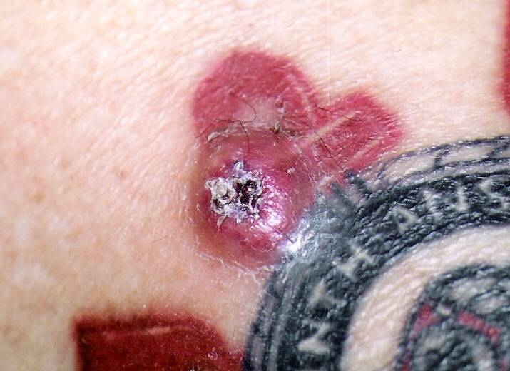 keratoacanthoma in tattoo