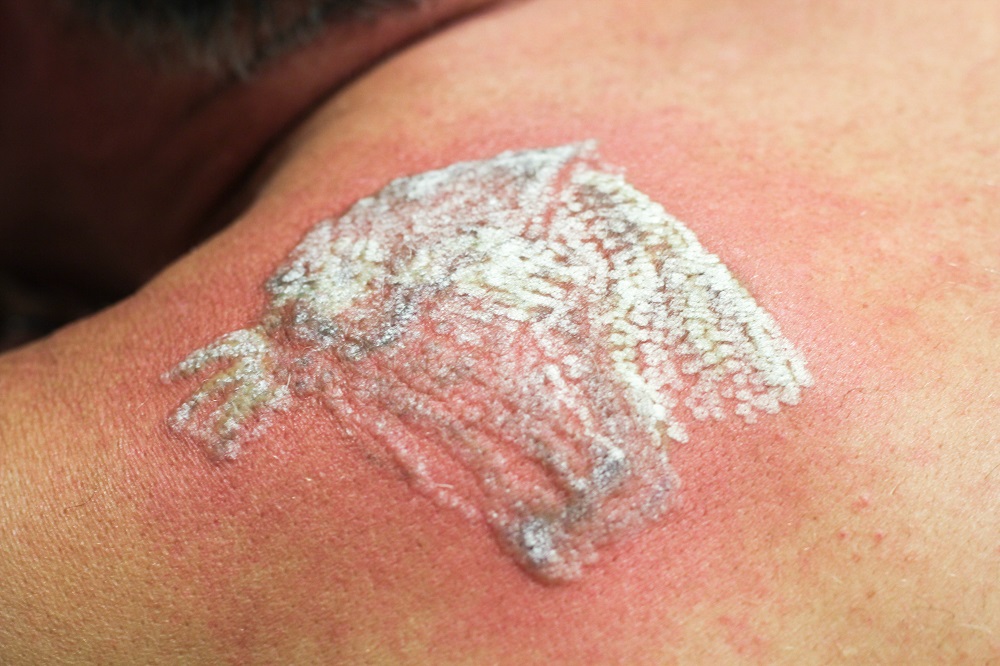 reddening-after-tattoo-laser-treatment