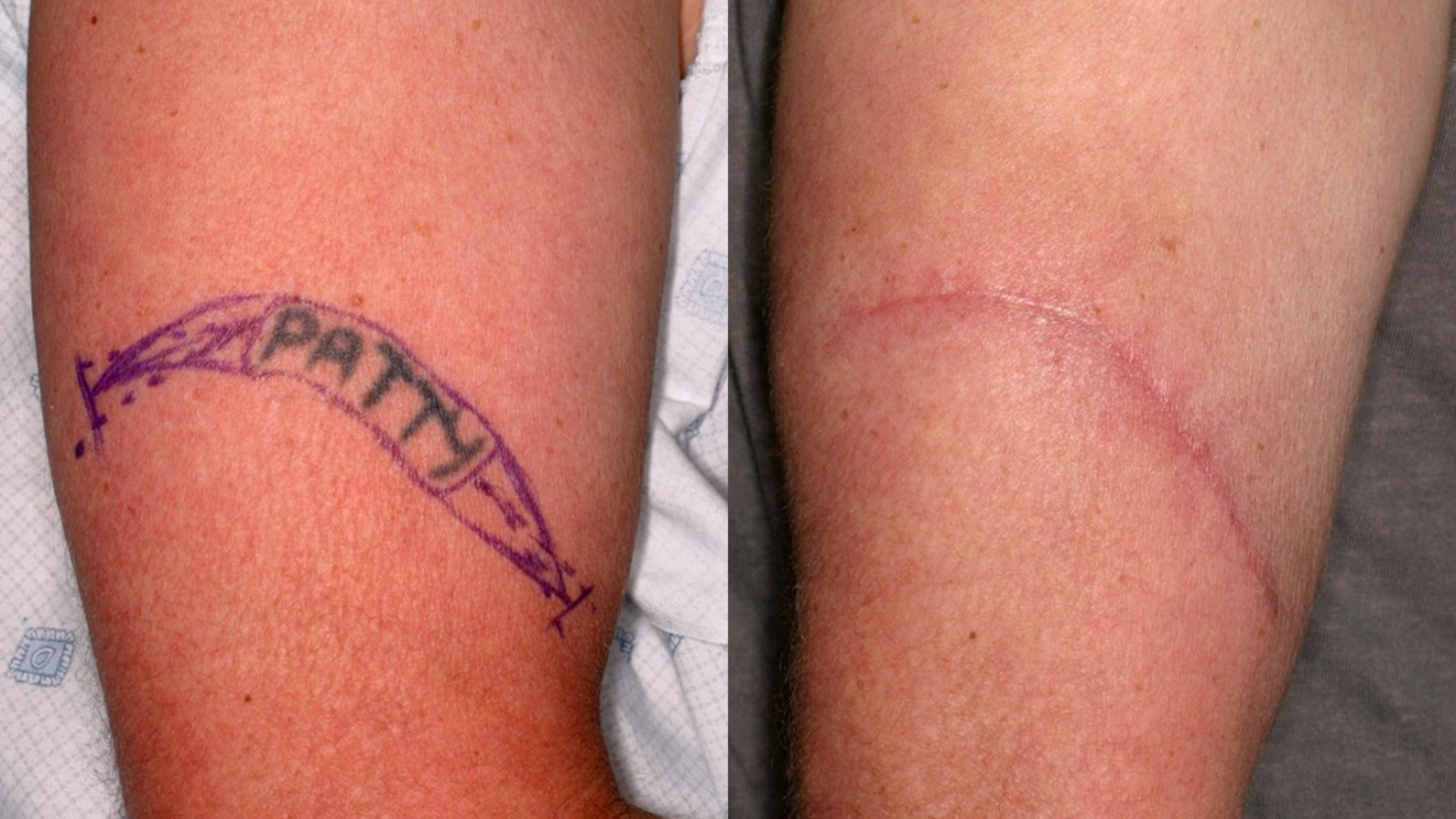 surgical-tattoo-removal1