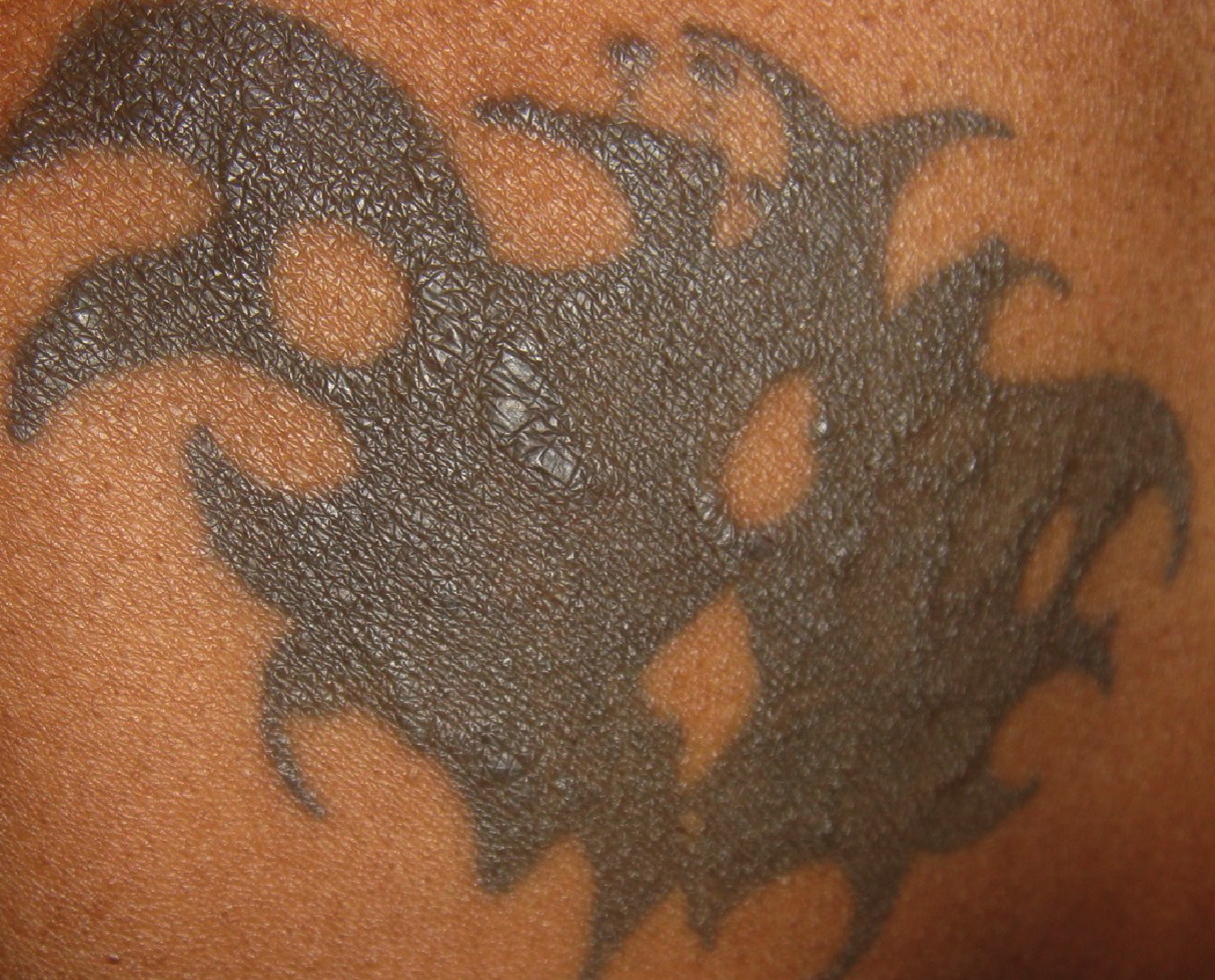 tattoo granuloma