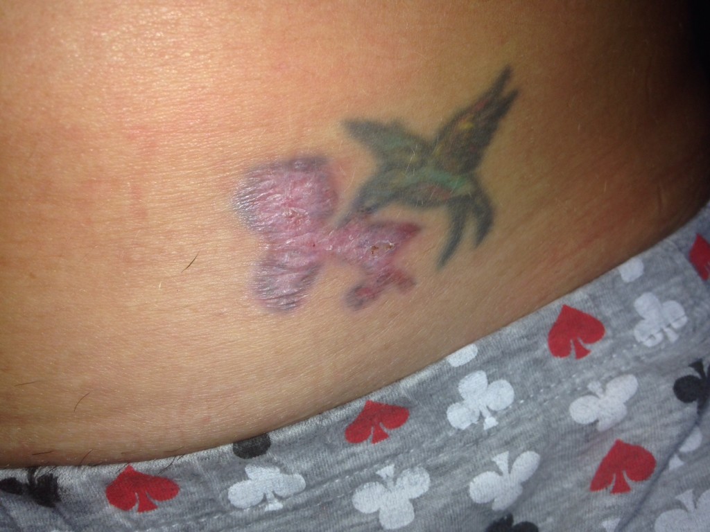 Tatoo only one month after the first treatment