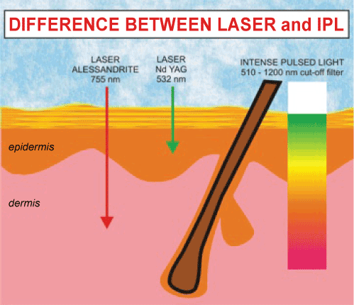 laser and IPL