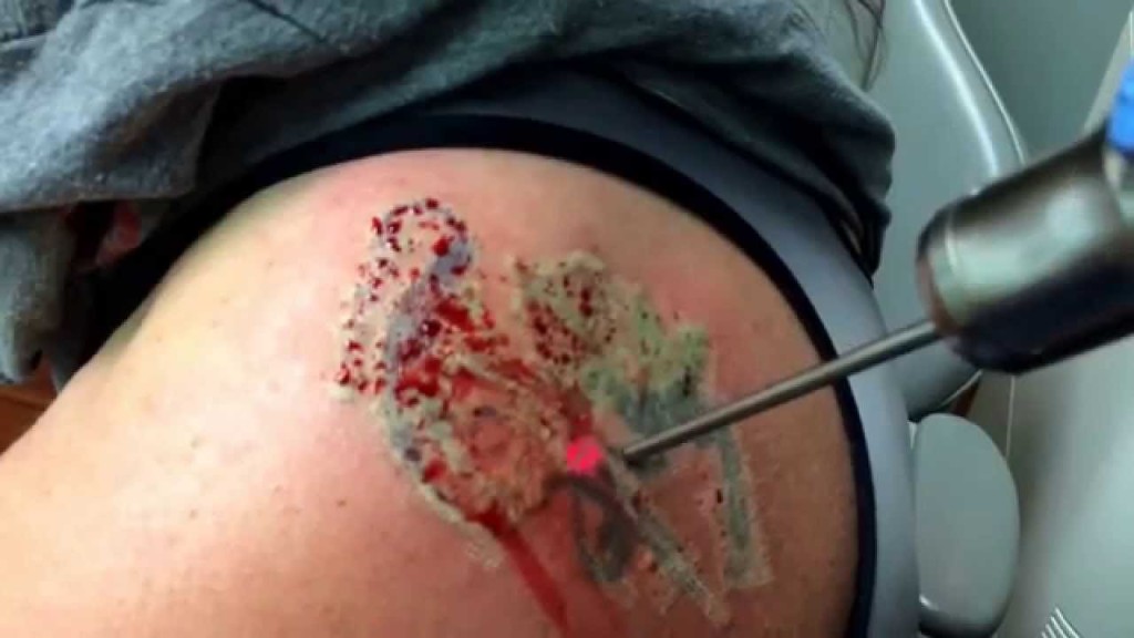 laser-tattoo-removal beeding