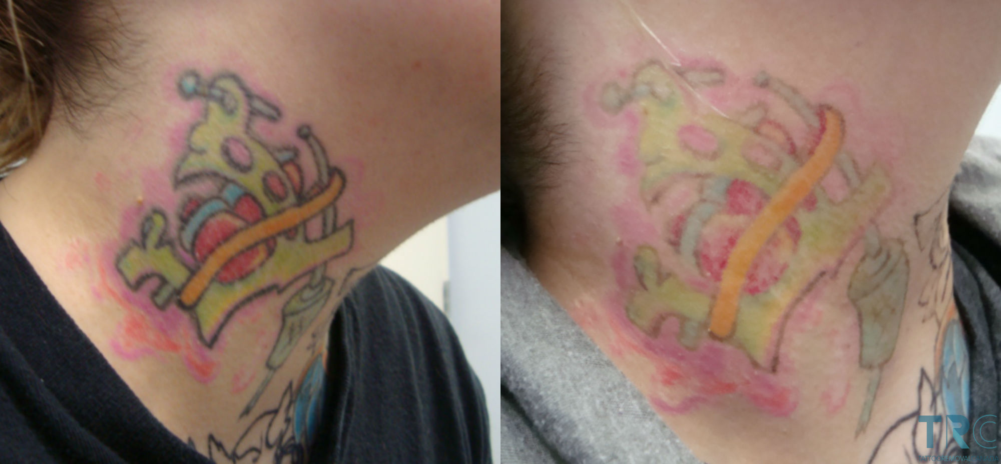 laser-tattoo-removal-beforeandafter-session3