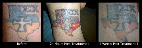 laser tattoo removal blistering_before.after_