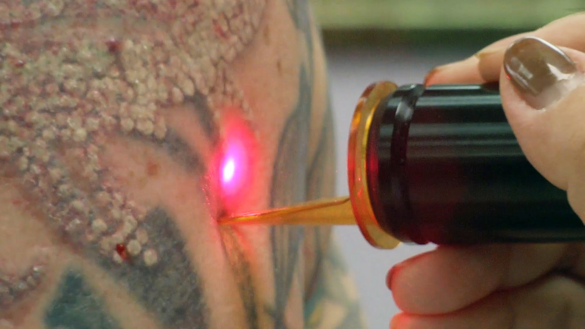 burbuja Comercialización Despido Remoción de tatuajes con láser – VoltaicPlasma – Areton LTD