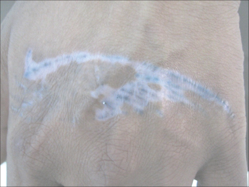 laser tattoo tremoval hypopigmentation