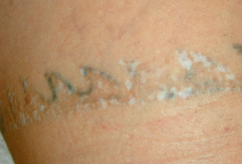 laser_removal_treatment