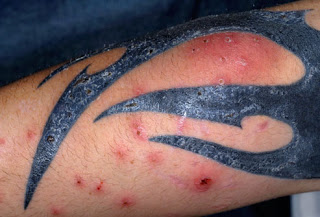 tattoo allergic reaction2