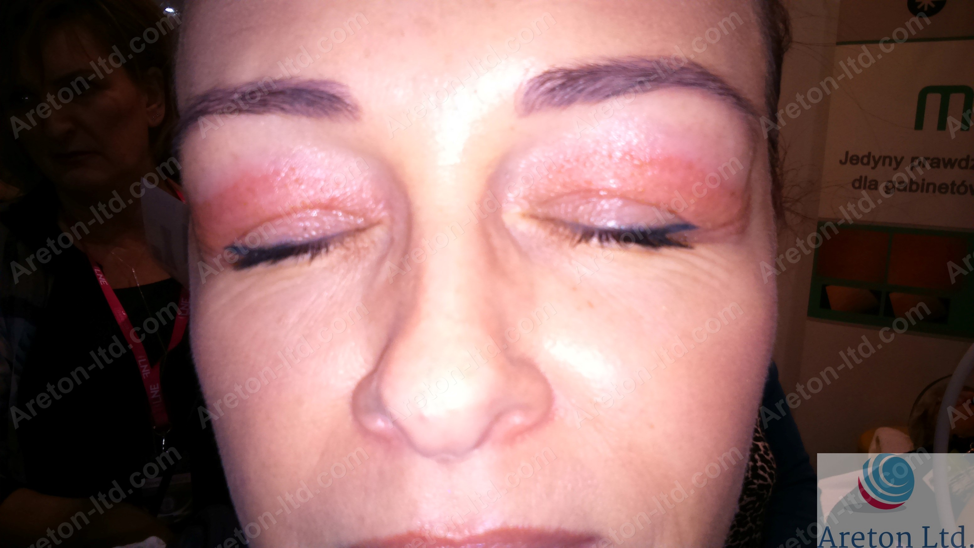Lower eyelid tightening case study – VoltaicPlasma – Areton LTD