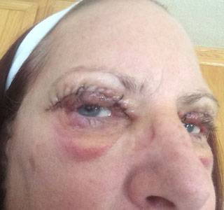 Eyelid-surgery-scar-blepharoplasty