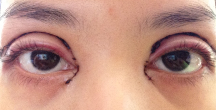 double-eyelid-surgery-gone-bad