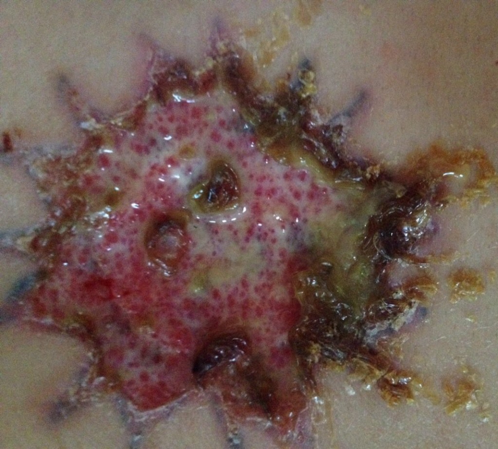 tattoo removal inflamatory infection