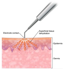 Electrodessication