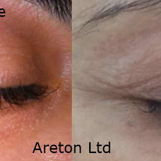 upper and lower right eyelid before and after for publication